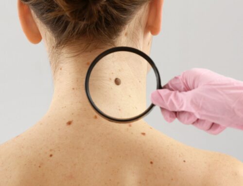 ¿Se curará el cáncer de piel sin cirugía?