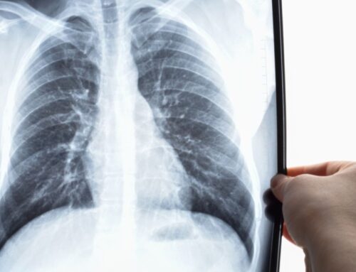 Programa de screening de cáncer de pulmón: una alianza para luchar contra la enfermedad